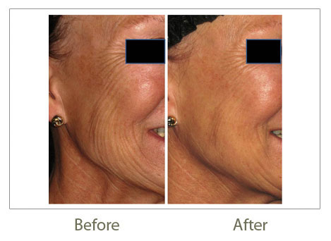PRP Treatments before after