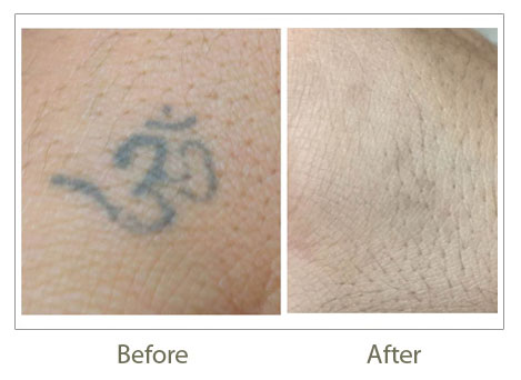 Tattoo Removal Treatment Images