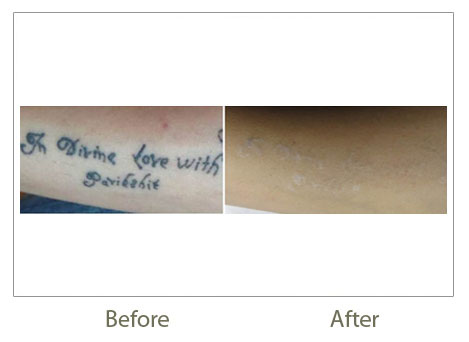 Tailored Tattoo Removal Melbourne